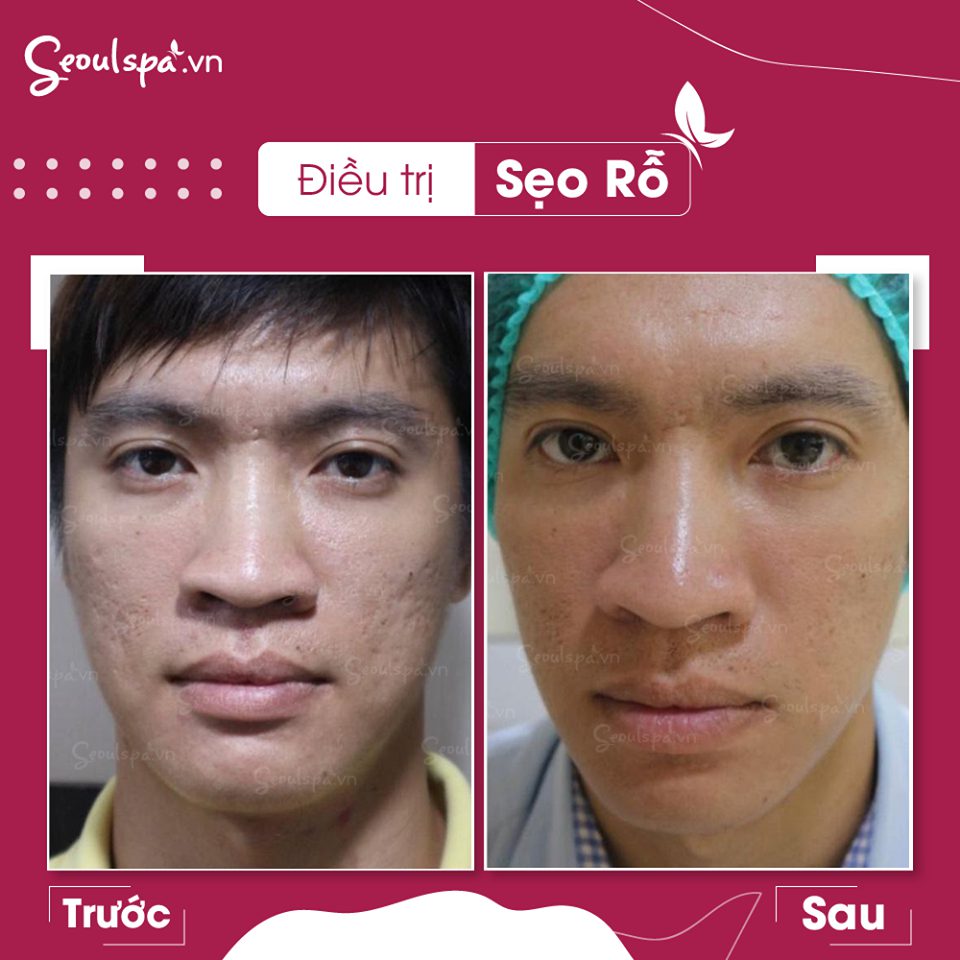 Chi phí điều trị phụ thuộc vào tình trạng sẹo mụn của bạn nặng hay nhẹ