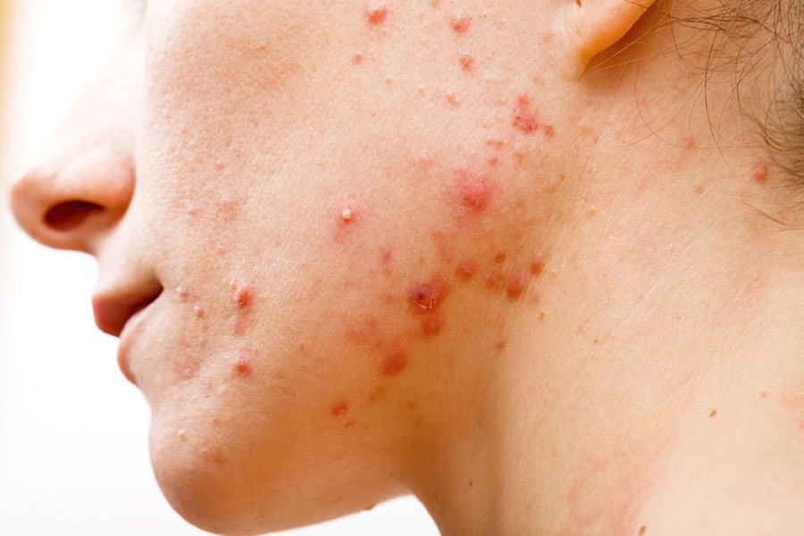 mụn trứng cá là thể nặng của mụn viêm