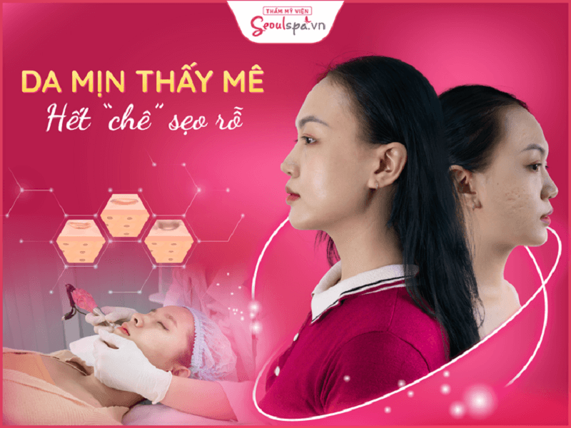 Top 20+ Co Ai Tri Seo Ro O Doctor Scar Chua DR. Seoul Trị Sẹo Rỗ SEL 5.0 - Điều trị tận gốc sẹo cam kết không tái lại 25 Khi điều trị ở Bs thì da láng mịn, sạch sẹo lõm. Seoul SEL 5.0
