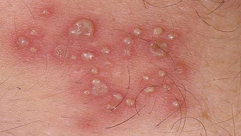 Có thể xuất hiện mụn ở vùng kín khi dùng vaseline