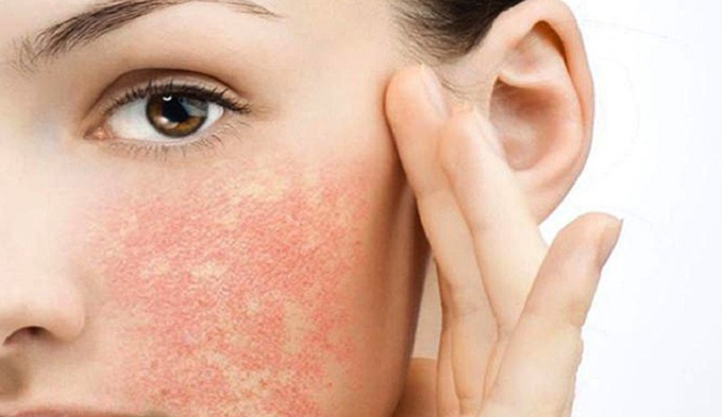 Top 20+ Mặt Bị Sưng Sau Khi Lăn Kim Biến chứng của lăn kim thường gặp: Nguyên nhân và cách phòng ngừa 23 Biến chứng của lăn kim đến từ nhiều nguyên nhân khác nhau