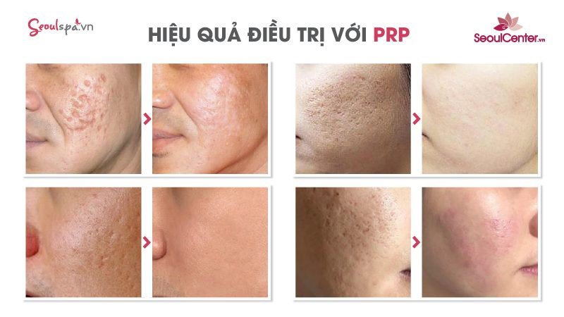 Công nghệ PRP 4.0 trị sẹo cùng với Seoul Spa