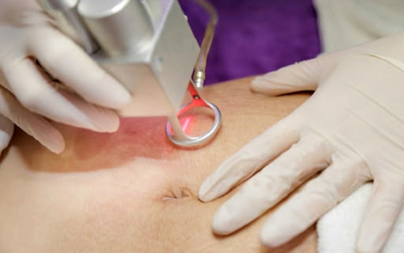 Top 20+ Trị Rạn Da Bằng Laser Bao Nhiêu Tiền Trị rạn da bằng laser bao nhiêu tiền? Có hiệu quả không? 25 Trị rạn da lâu năm bằng laser cải thiện đến 80%