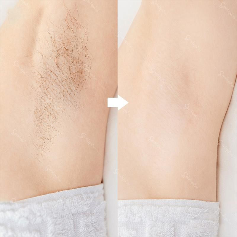 Làn da mịn màng trắng sáng sau khi triệt lông tại Seoul Spa