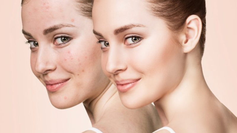 Các sản phẩm kem trị mụn đặc trị