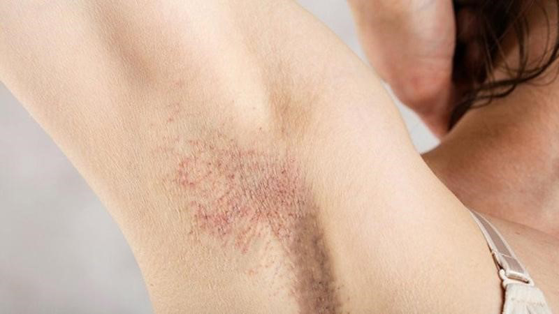 Nguyên nhân khiến nhiều bạn lựa chọn triệt lông tại spa