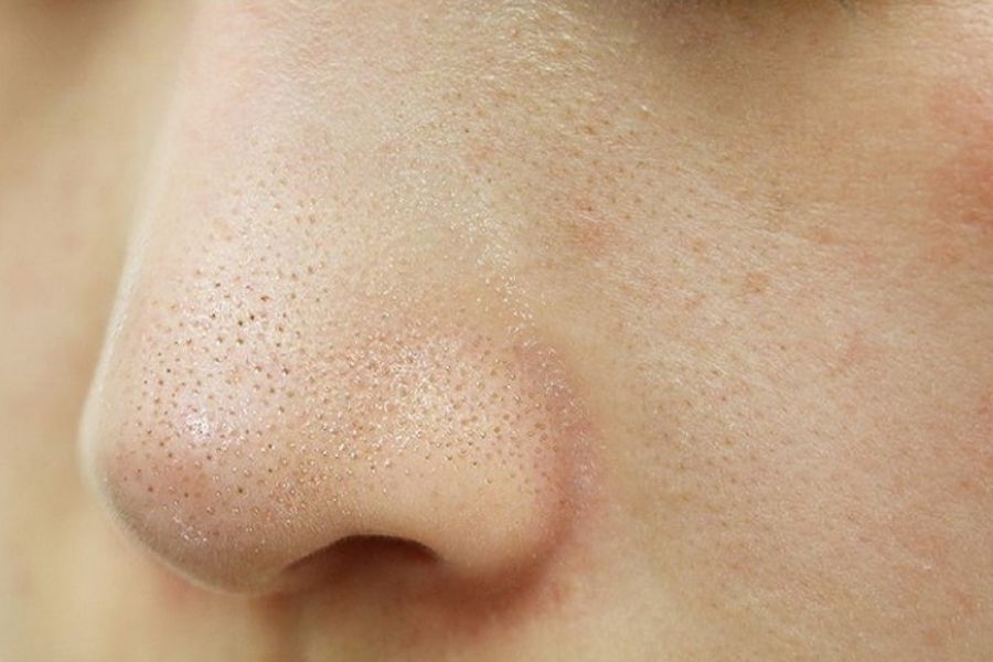 Lỗ chân lông bị tắc nghẽn dẫn đến mụn cám hình thành trên da