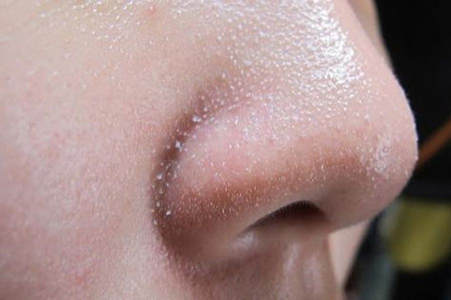 Mụn cám gây bít tắc lỗ chân lông, còn sợi bã nhờn thì không