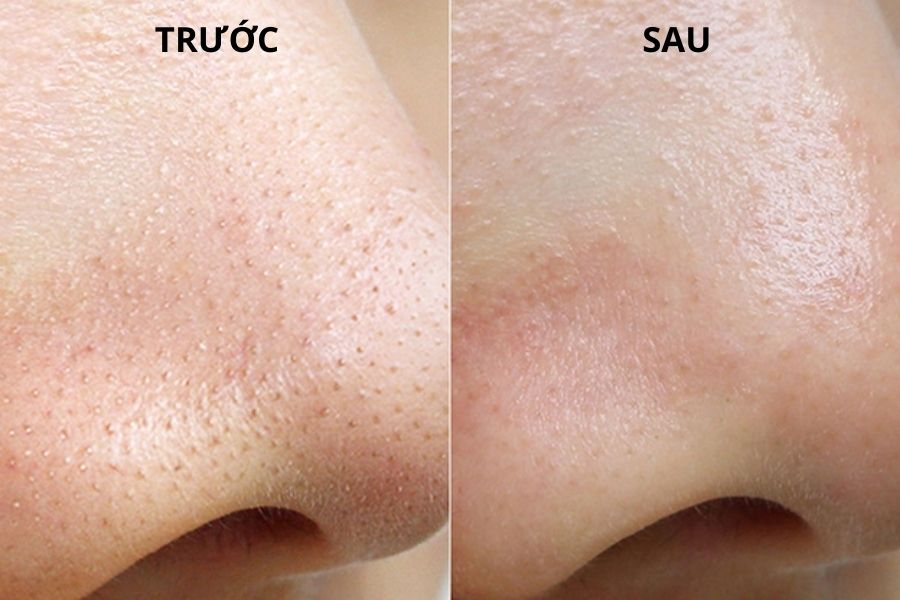 Tình trạng mụn cám giảm rõ rệt sau điều trị