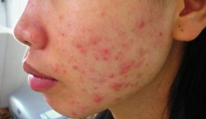 Làn da bị nhiễm chì sẽ xuất hiện nhiều mụn mủ, mụn bọc gây đau đớn, mất thẩm mỹ