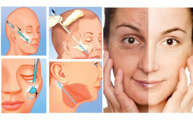 Nội soi cắt da vùng mắt giúp cải thiện lão hóa da mắt hiệu quả