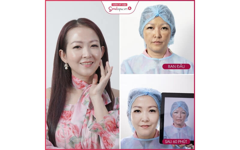 Seoul Spa là địa chỉ cung cấp dịch vụ cách làm căng da vùng mắt hiện đại