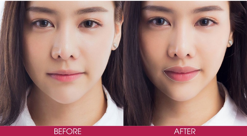 Kết quả tiêm filler môi chất lượng tại Seoul Spa
