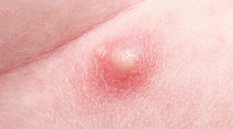 Mụn nhọt vùng mông xuất hiện do lỗ chân lông bít tắc