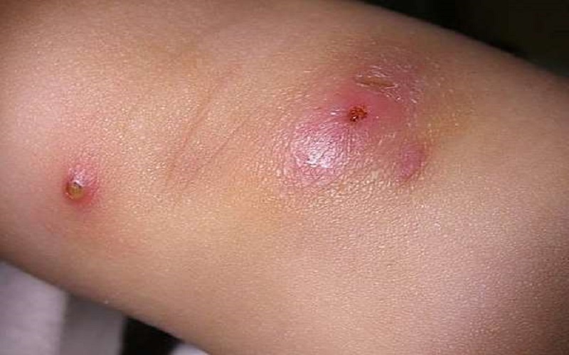 Xử lý khi mụn nhọt mới mọc