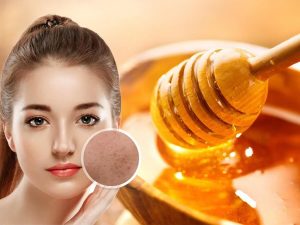 Cách trị mụn ở tuổi 12, 13, 14 an toàn và phù hợp với lứa tuổi 23 Trị mụn với nước cốt chanh