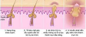 Cách trị mụn ở tuổi 12, 13, 14 an toàn và phù hợp với lứa tuổi 5 Gạo là phương pháp trị mụn an toàn và lành tính cho da tuổi dậy thì