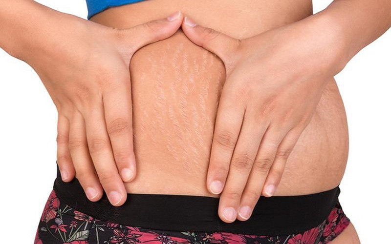Rạn da khi tăng cân khiến cơ thể mất đi vẻ đẹp vốn có của làn da
