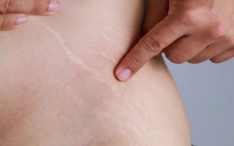 Sữa bò tươi tăng cường protein hỗ trợ da lành nhanh chóng