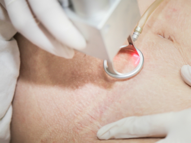 Điều trị rạn da bằng laser