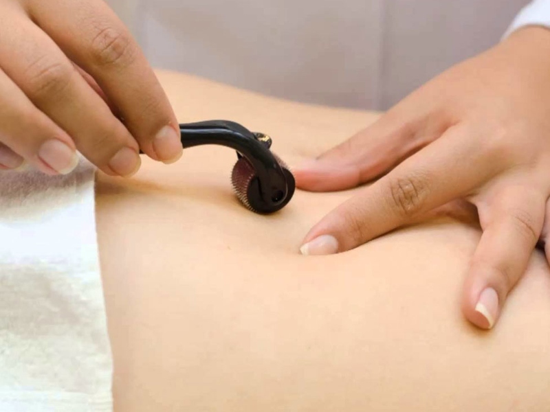 Lăn kim chữa được nhiều vấn đề về da, trong đó có rạn da