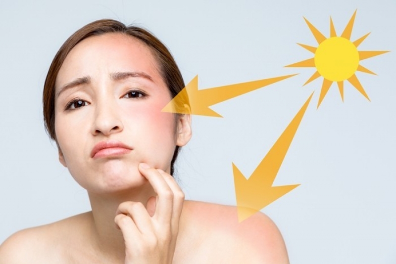 Nên sử dụng kem chống nắng để tránh tác hại của tia tử ngoại
