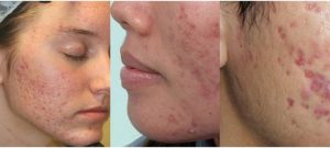 Cách trị thâm mụn tại nhà 1 Cách trị thâm mụn tại nhà Thâm mụn hình thành là do các sắc tố melanin tăng sinh mạnh mẽ, khiến chúng ngày càng đậm màu, làm ảnh hưởng trầm trọng đến thẩm mỹ gương mặt