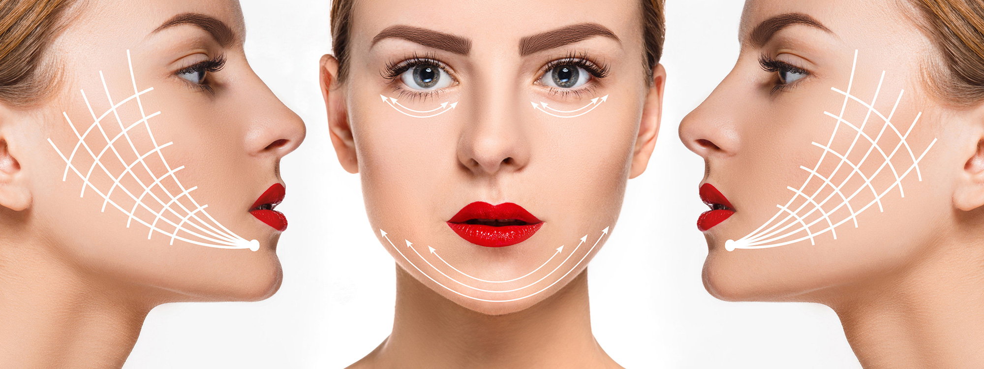 Căng chỉ collagen là phương pháp luồn chỉ sinh học collagen để tạo mạng lưới liên kết giúp kéo căng và nâng đỡ vùng da chảy xệ, chùng nhão