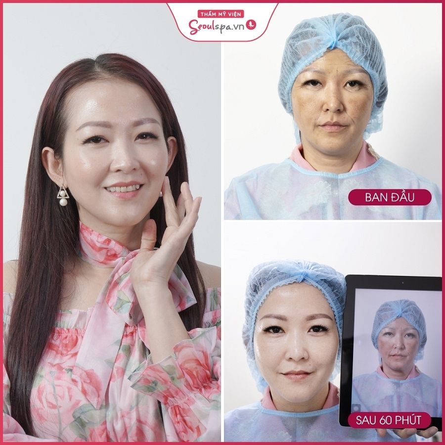 Gương mặt khách hàng trẻ hóa toàn diện sau khi căng chỉ collagen