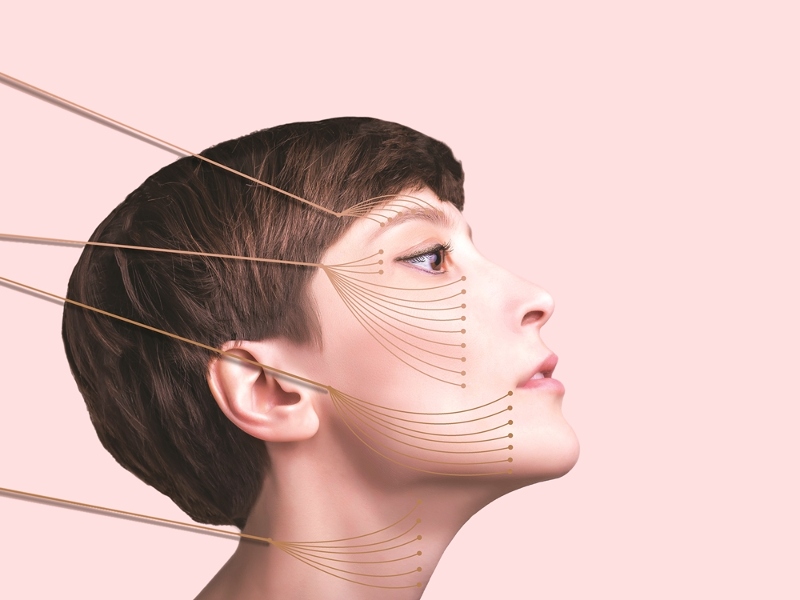 Căng da mặt bằng chỉ collagen có tốt không?
