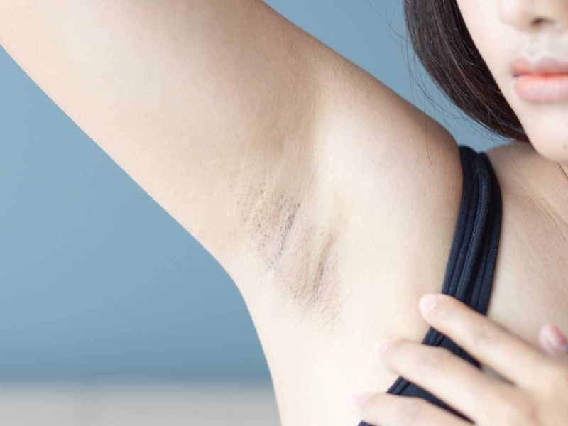 Cạo lông nách có bị thâm không?