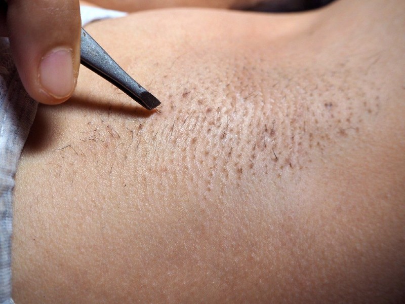 Cạo lông nách có bị thâm và nổi mẩn đỏ, ngứa rát, khó chịu nếu không thực hiện đúng cách