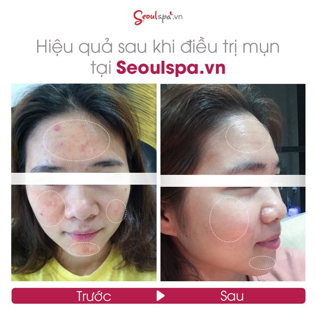 Kết quả chăm sóc da mụn tại SeoulSpa.Vn