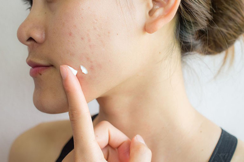 Kem trị mụn giúp gom cồi mụn, diệt khuẩn, giảm viêm mụn hiệu quả