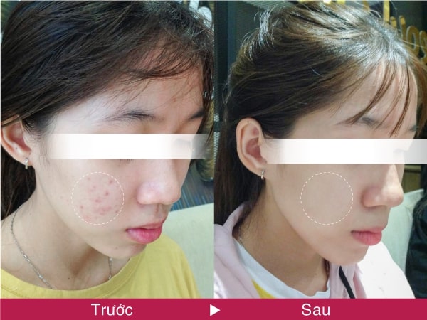 đi spa trị mụn có hết không