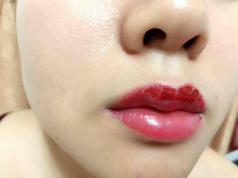 Thời gian bong vảy và lên màu sau khi dặm môi lần 2 là khoảng 6-8 ngày