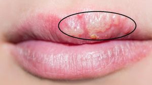 Những dấu hiệu phun môi bị hỏng và cách khắc phục 2 Môi bị hỏng sau phun