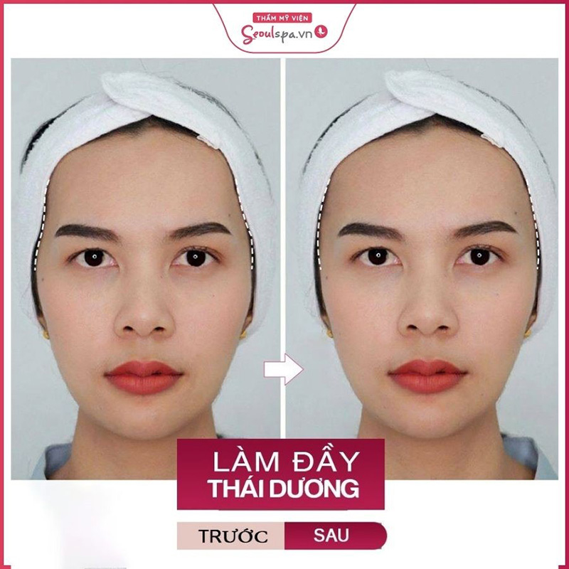 Tiêm filler tại Seoul Spa đem lại kết quả nhanh chóng