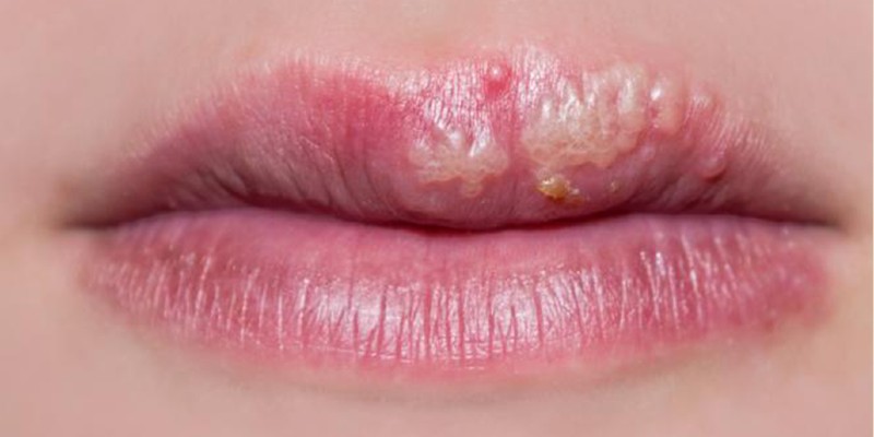 Khi tiêm filler hỏng, đôi môi của bạn sẽ bị rộp, ngứa rát, đau trong thời gian dài mà không thuyên giảm