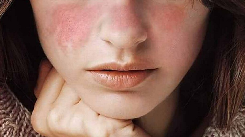 Tiêm filler hỏng sẽ khiến má bạn bị kích ứng, đen sạm