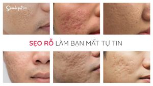 Lăn kim trị sẹo rỗ - Cách lăn kim trị sẹo rỗ tại nhà an toàn