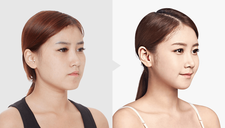 Hiệu quả của Botox sẽ duy trì ngắn hay dài tùy thuộc vào nhiều yếu tố