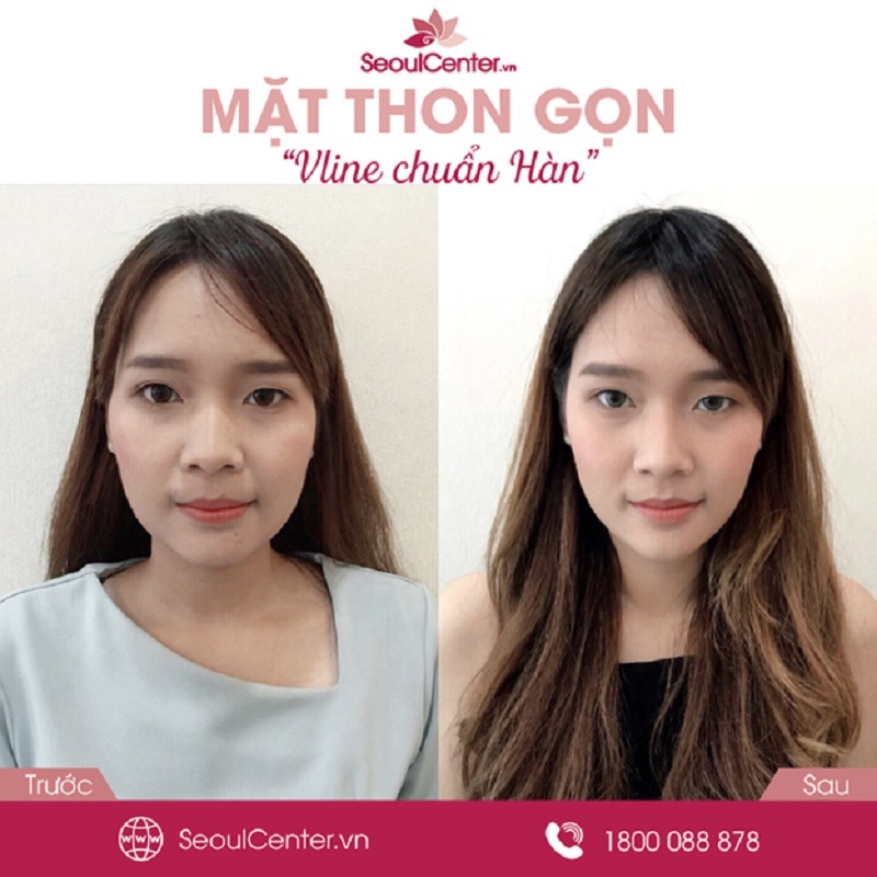Khách hàng sử dụng dịch vụ thon gọn hàm, cân đối gương mặt của Seoul Center