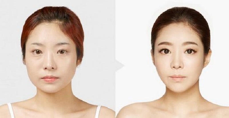 Tiêm Botox có công dụng thon gọn hàm