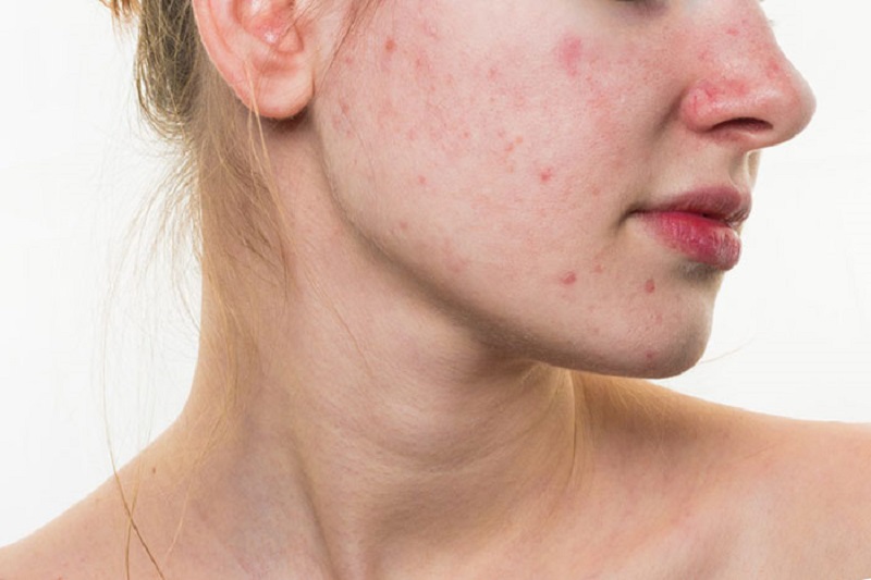 Trị mụn giá rẻ là giải pháp tối ưu nhất dành cho sinh viên