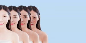 Điều trị nám da bằng laser - những thông tin quan trọng phải biết!