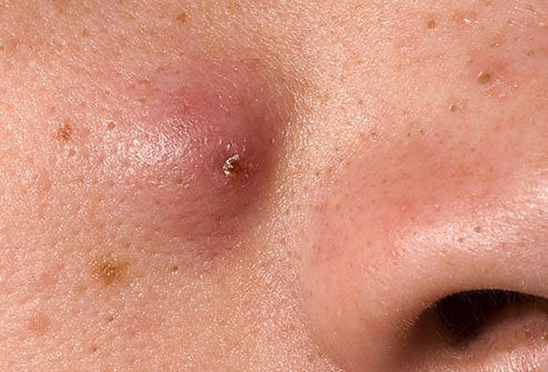 Một số loại mụn không nên dùng cây nặn mụn để nặn