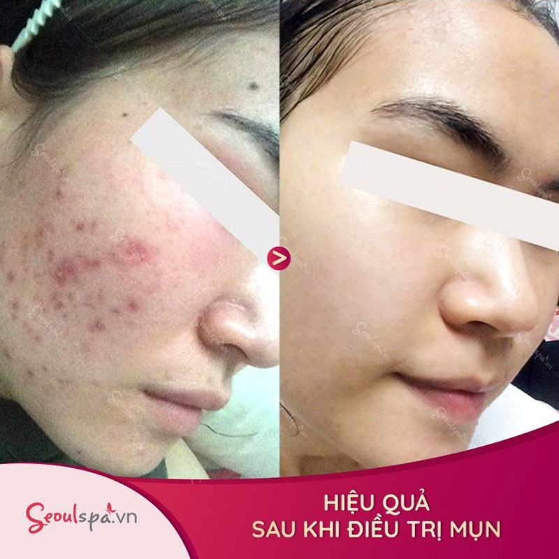 Thực hiện trị mụn tại spa giúp đánh bay tất cả loại mụn nhanh chóng và an toàn