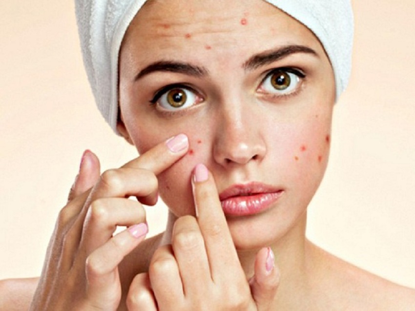 Không nặn mụn bằng tay tránh để lại sẹo