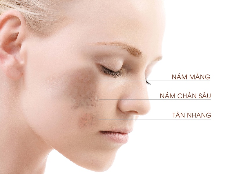Nám và tàn nhang có đặc điểm hình dáng khác nhau